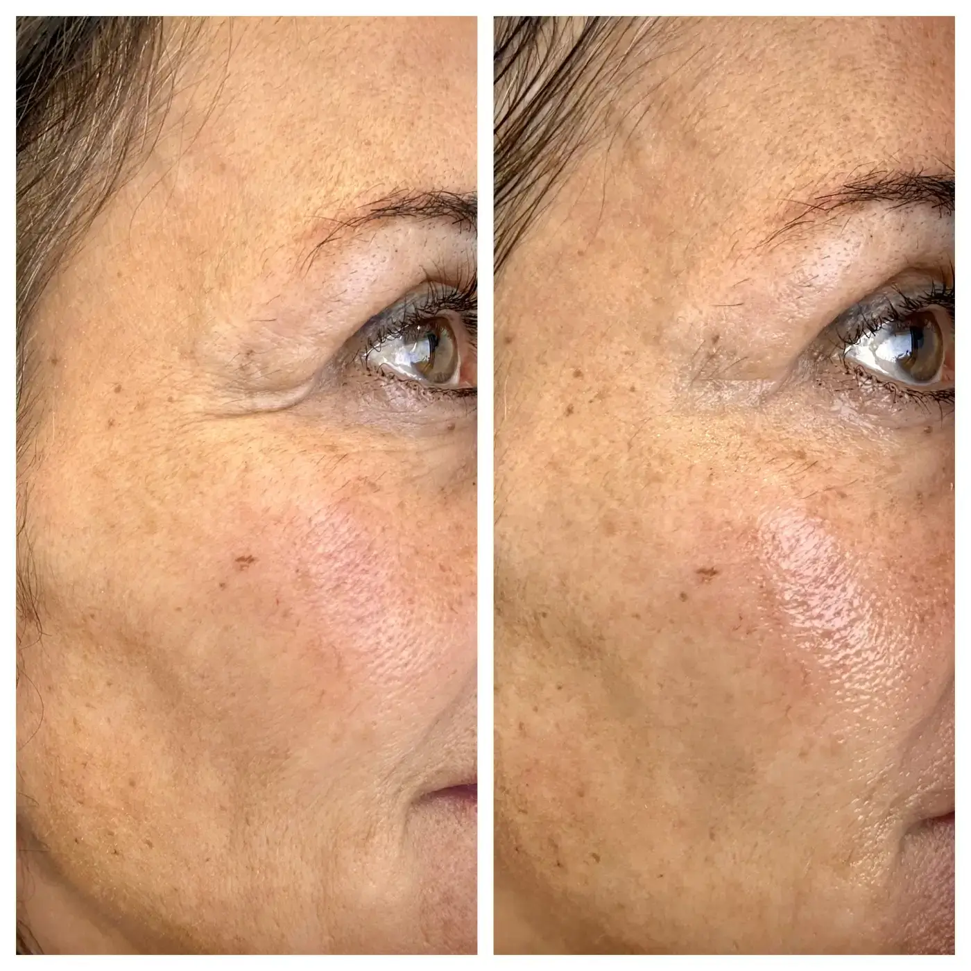 CFU Facelifting AURORA Ergebnis (1)