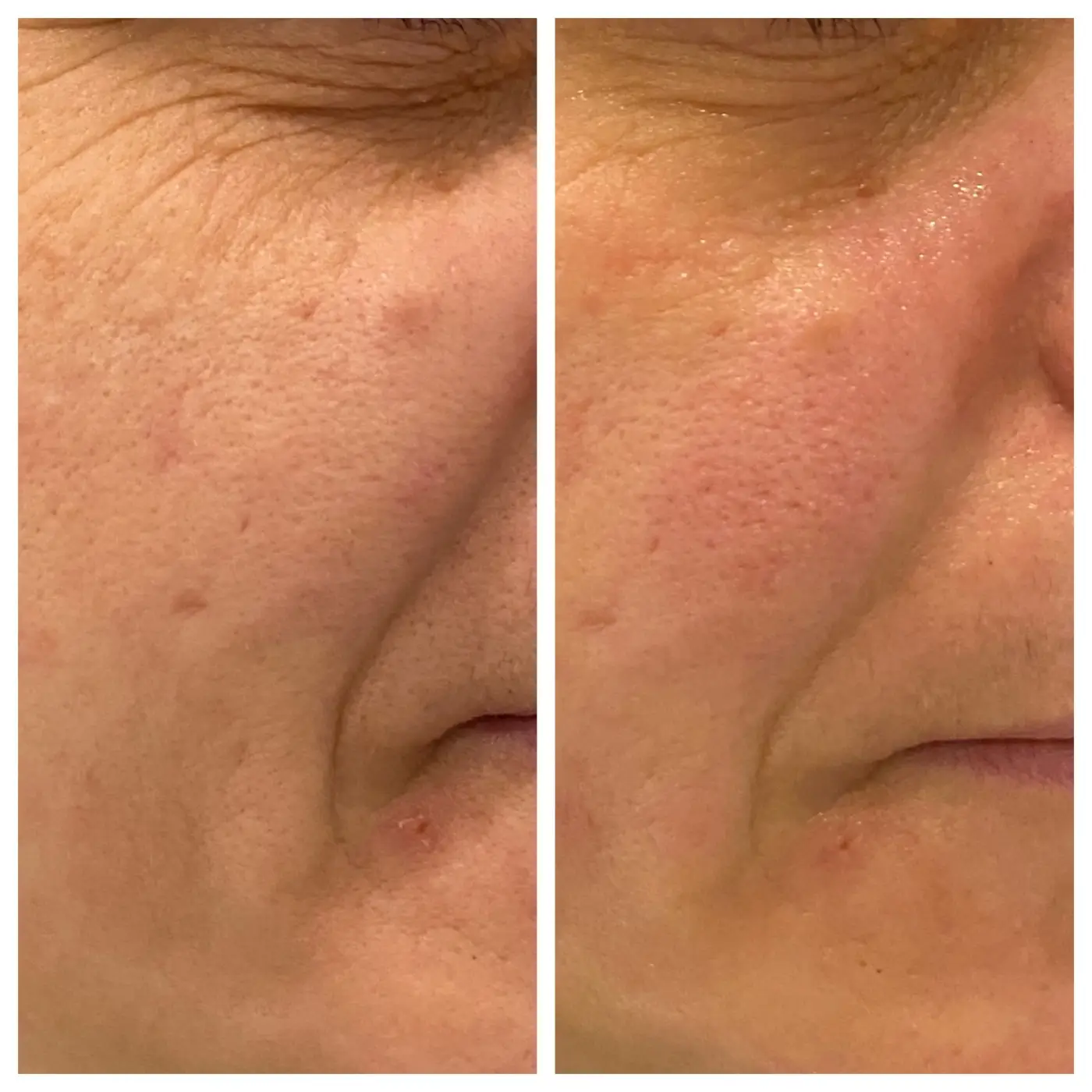 CFU Facelifting AURORA Ergebnis (3)