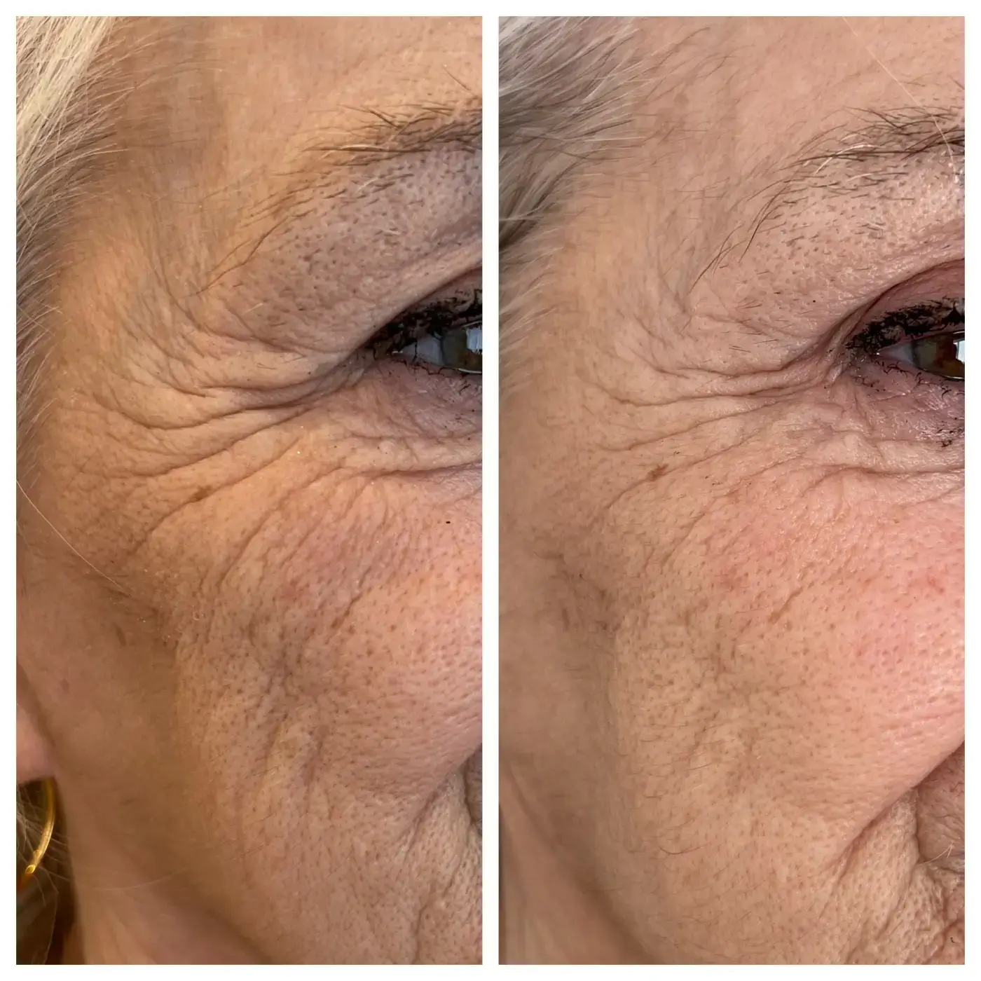 CFU Facelifting AURORA Ergebnis (5)