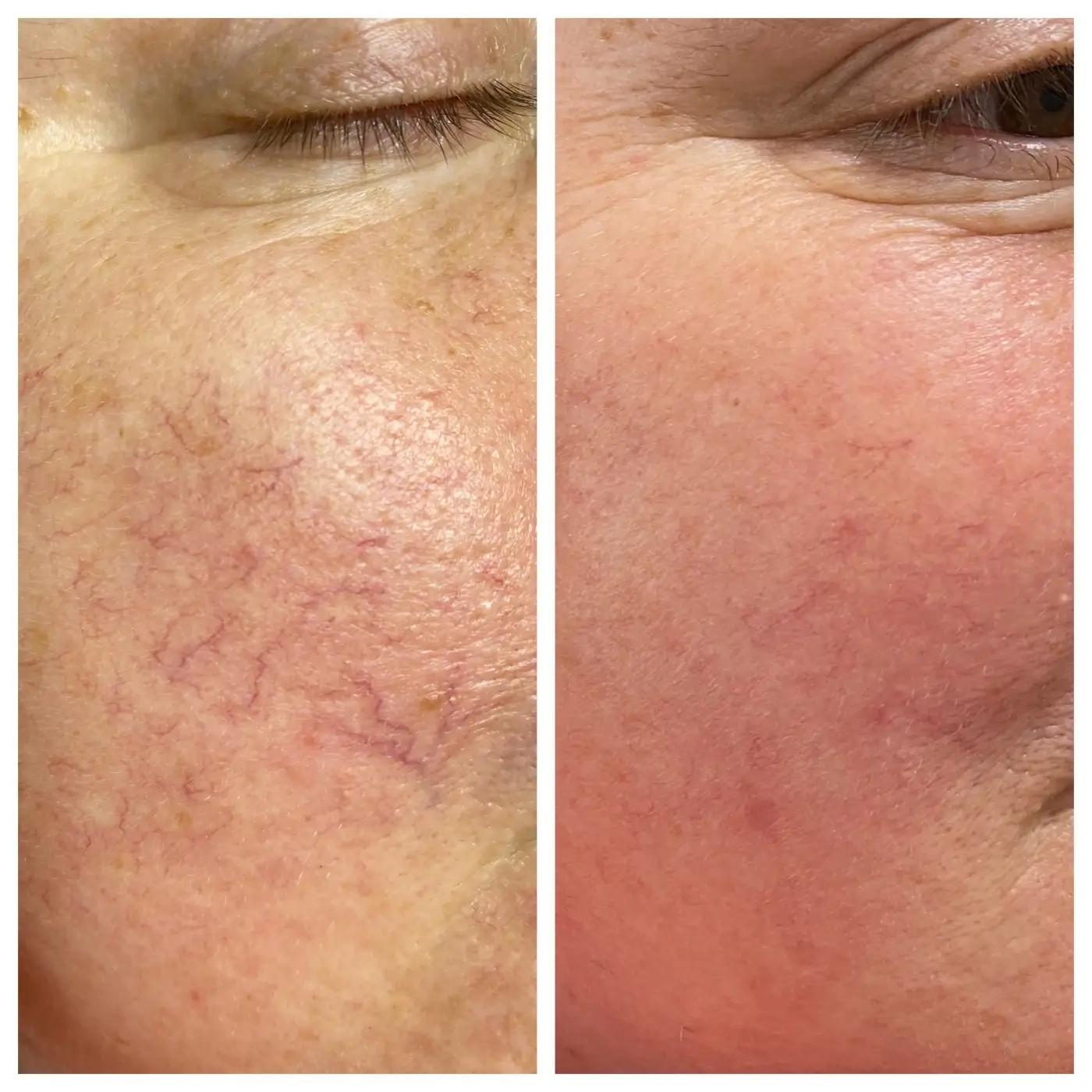 Couperose Behandlung AURORA Ergebnis (1)
