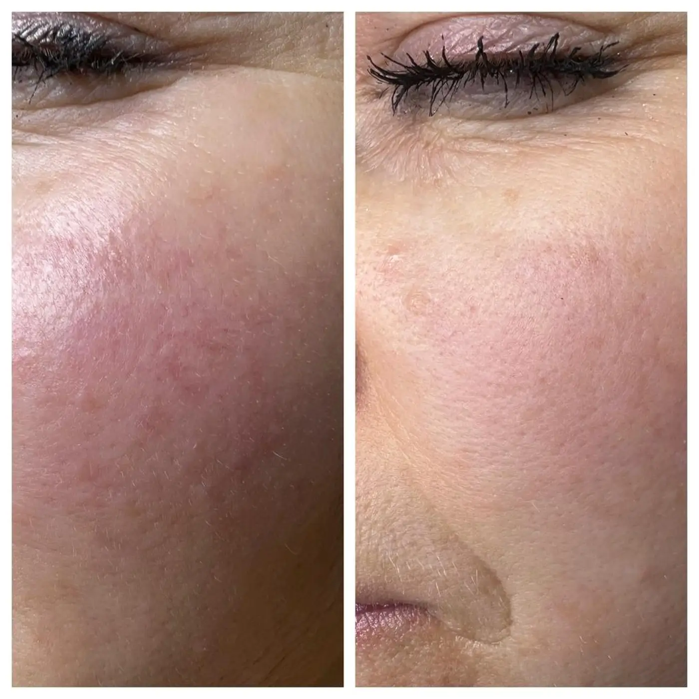 Couperose Behandlung AURORA Ergebnis (2)