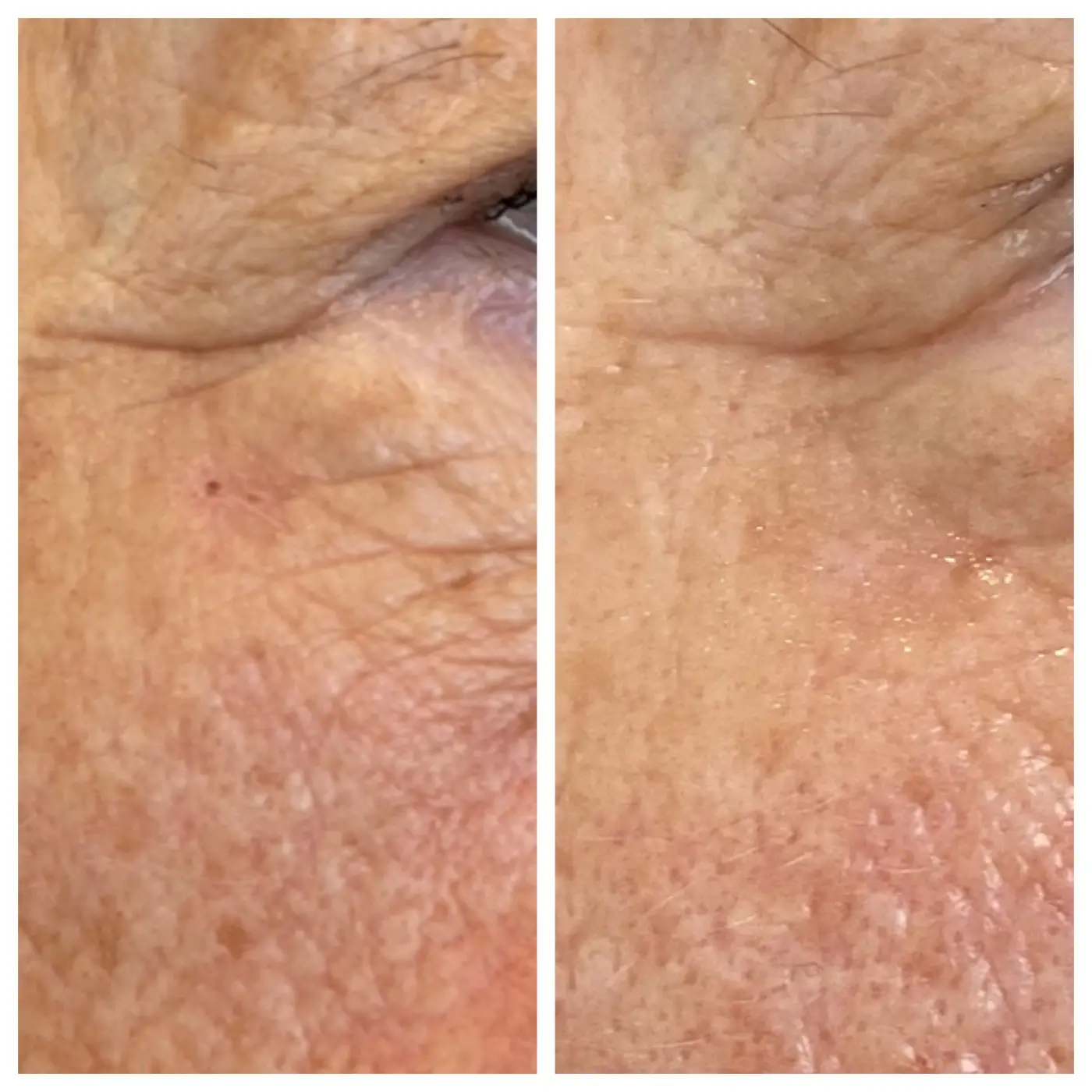 HIFU Lifting AURORA Ergebnis (1)