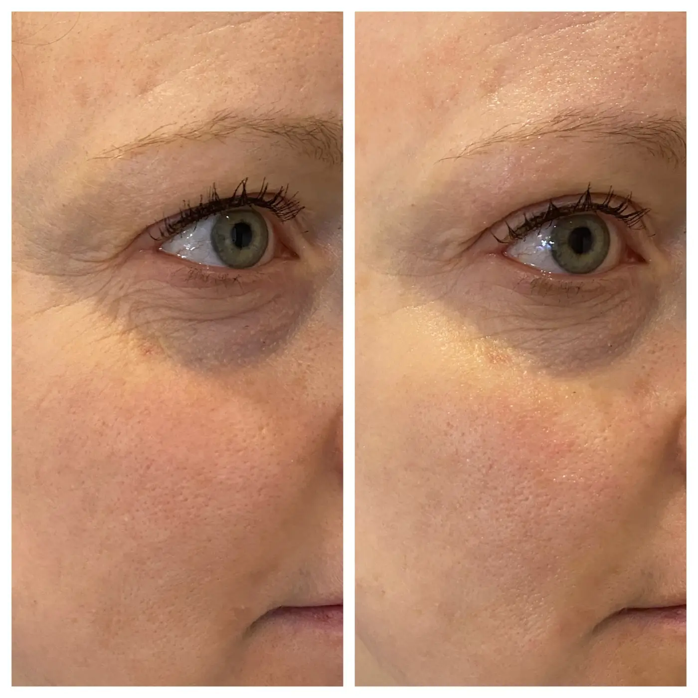 HIFU Lifting AURORA Ergebnis (3)