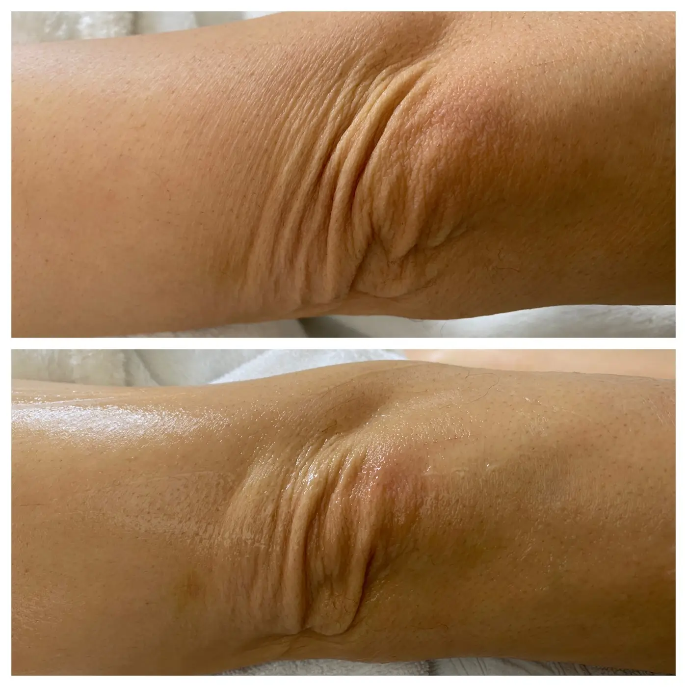 HIFU Lifting AURORA Ergebnis (4)