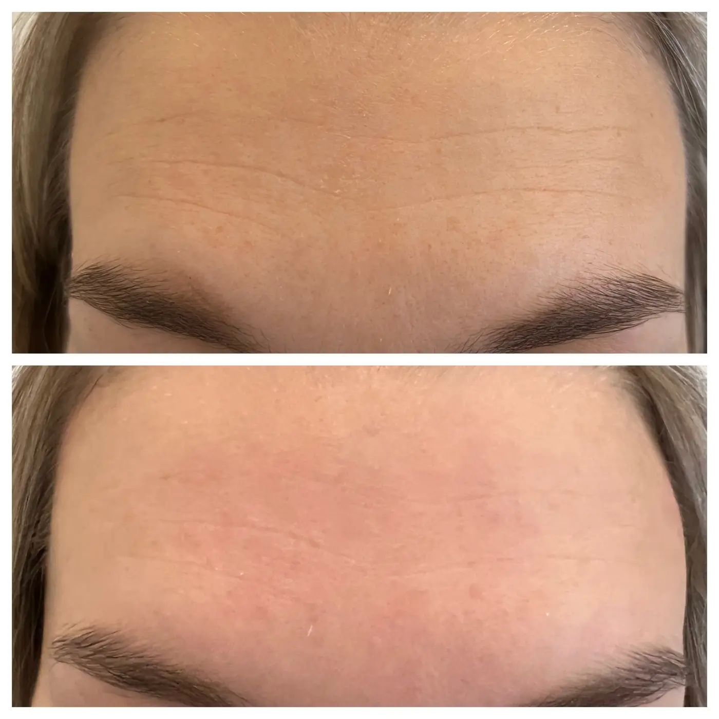 HIFU Lifting AURORA Ergebnis (5)