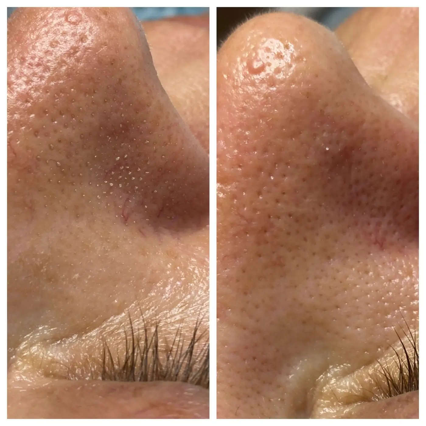 AquaFacial AURORA Ergebnis (2)