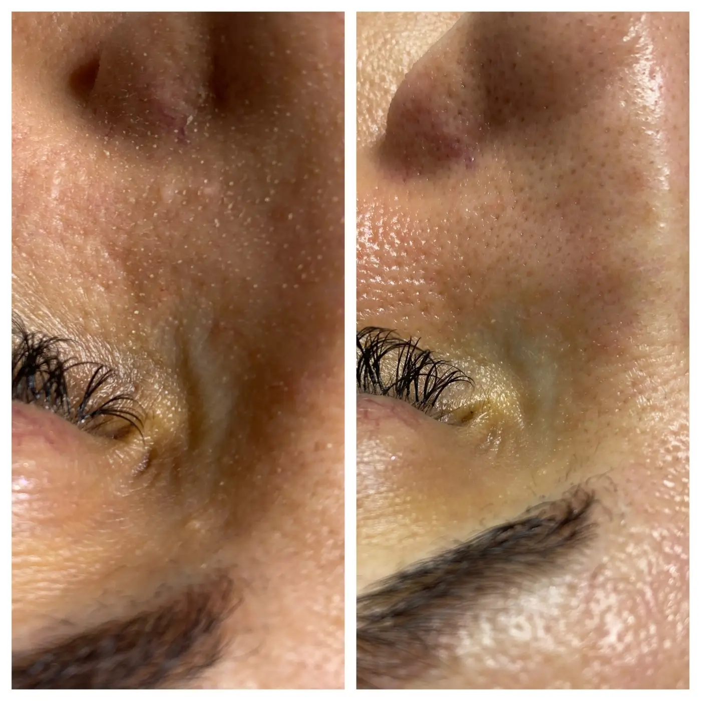 AquaFacial AURORA Ergebnis (3)